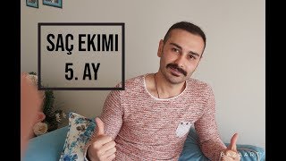 SAÇ EKİMİ 5 AY [upl. by Onitnatsnoc]