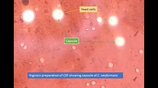 Cryptococcus capsules in Nigrosin preparation [upl. by Yenor]