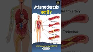 Atherosclerosis के क्या है  Causes sign and symptoms atherosclerosis testpaperlive shorts [upl. by Lamoureux340]