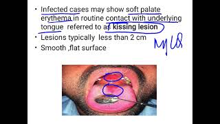 Median Rhomboid Glossitis [upl. by Binny]