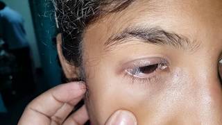 eczema of upper eyelid allergic conjunctivitis chronic [upl. by Lednyk457]