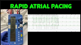 Rapid atrial pacing [upl. by Ravens]