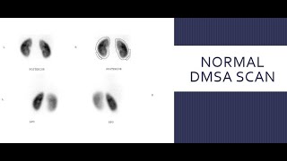 Static Renal Scintigraphy MCQ DMSA RenalScintigraphy renalscan scfhs nuclearmedicineMCQ [upl. by Winola]