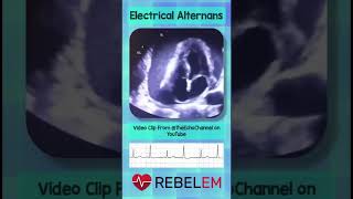 Electrical Alternans REBELEM ECG EKG PericardialEffusion ElectricalAlternans FOAMus MedEd [upl. by Joaquin]