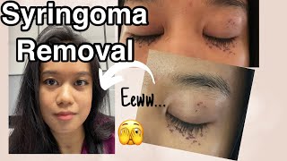 My Syringoma Removal process with pictures [upl. by Nolyag]