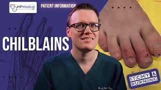 How To Get Rid Of CHILBLAINS Pernio Itchy Sores On Your Fingers And Toes  Doctor Explains [upl. by Tab811]