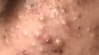 Huge Acne Pimples Blackheads Popping Up Satisfying with Oddly Calm Music [upl. by Aliled]