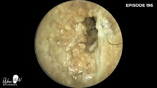 196  Swimming induced Otitis Externa Outer Ear Infection Removal with WAXscope®️ [upl. by Suiramaj170]