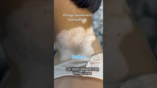 VITILIGO PERMANENT COSMETIC TATTOOING  VITILIGO TREATMENT  vitiligoindia whitespottreatment [upl. by Teloiv801]