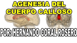 AGENESIA DEL CUERPO CALLOSO  FALTA DE FORMACIÓN EN LA REGIÓN CEREBRAL [upl. by Iphigenia931]