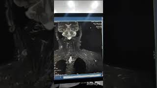 ct scan wholebody ctscan medical radiology [upl. by Aihsemaj]