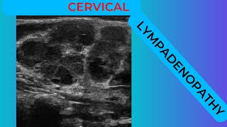 Cervical lymphadenopathy conglomerating nodes on ultrasound scan [upl. by Senoj240]