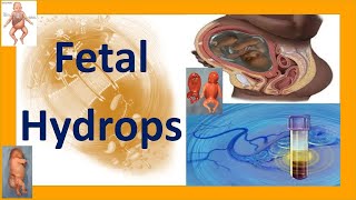 Fetal Hydrops  Hydrops Fetalis  Fetal Hydrops Causes Complications Treatment and Prognosis [upl. by Nidroj]