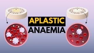 Aplastic Anaemia Causes Signs and Symptoms Diagnosis and Treatment [upl. by Minoru681]