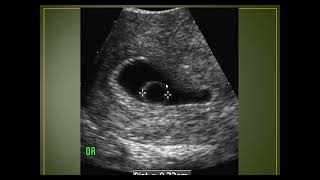 Large yolk sac as bad prognostic sign [upl. by Sherer]