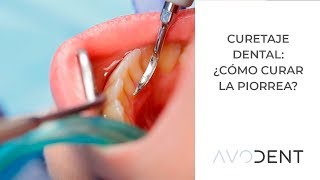 Curetaje dental ¿cómo se cura la piorrea  Clínica dental en Alcobendas  Avodent [upl. by Assirralc]