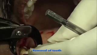 Mandibular right first molar extraction using Physics forceps [upl. by Nahbois349]