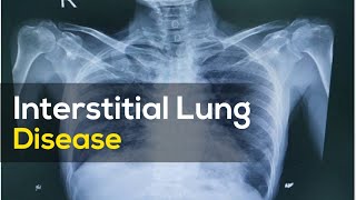 Interstitial Lung Disease  Pathophysiology  Explained  UrduHindi [upl. by Adebayo]