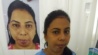 Amazing Face Transformation surgery Before amp After  Live [upl. by Lussier]