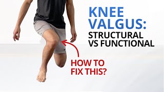 Why You Need to Fix Dynamic Knee Valgus NOW [upl. by Antonie]