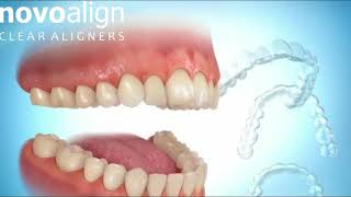 How NovoAlign Aligners move teeth [upl. by Ardnuassac475]