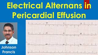 Electrical Alternans in Pericardial Effusion [upl. by Drannek]