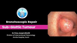 Subglottic Airway Tumour  Bronchoscopic management [upl. by Chansoo]