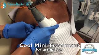 Cool Mini Coolsculpting Treatment for Armpit Fat [upl. by Laurene]