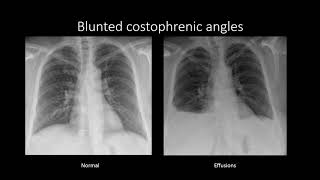 Drainage of pleural effusion  Lungs [upl. by Cameron25]