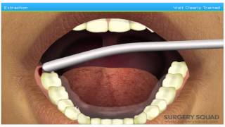 Surgery Games Wisdom Teeth EXTRACTION O [upl. by Eyot]