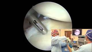 Arthroscopic Posterior Labral Repair  Randy S Schwartzberg MD [upl. by Dinin]