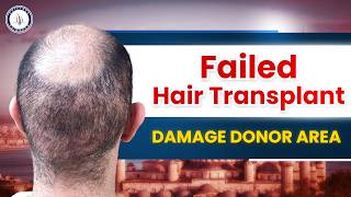 Hair Transplant in Kochi  Cost of Hair Transplant in Kochi  Hair Transplant Doctor in Kochi [upl. by Netty]