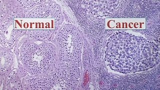 Testicular Cancer [upl. by Noyr]