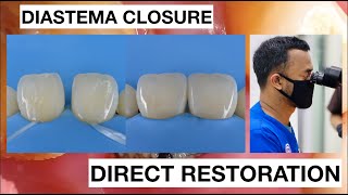 Diastema Closure with Direct Bonding Composite Restoration  General Dentist Griya RR [upl. by Hendry]