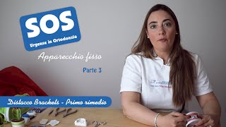 SOS Apparecchio Fisso  Distacco brackets  Primo rimedio [upl. by Drofiar]