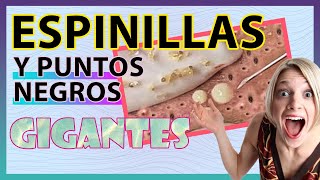 ✨🔥Recopilatorio Videos SATISFACCIÓN de sacar ESPINILLAS y PUNTOS NEGROS GIGANTES [upl. by Latrice]