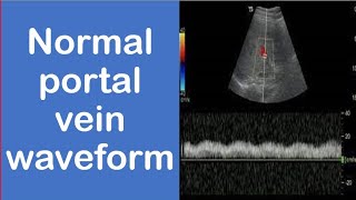 Normal portal vein waveform [upl. by Ymmaj]