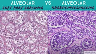 Alveolar Soft Part Sarcoma vs Alveolar Rhabdomyosarcoma [upl. by Wilhelm888]