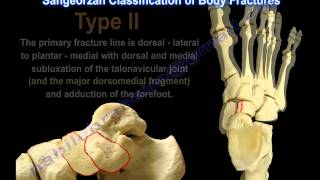 Navicular Fractures  Everything You Need To Know  Dr Nabil Ebraheim [upl. by Altman]