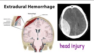 extradural hematoma  head trauma 1 headinjury [upl. by Enirol]