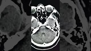 Chronic left MCA territory ischaemic infraction with the post infraction gliosis [upl. by Linsk19]