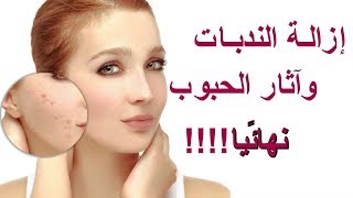 كريم رائع لإزالة آثار الحبوب والجروح بأقل من20dh [upl. by Norted367]