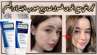 افضل غسول لعلاج الحبوب  العلاج السحري للحبوب  غسول بانوكسل لحبوب البشرة والجسم Panoxyl acne wash [upl. by Enoyrt795]