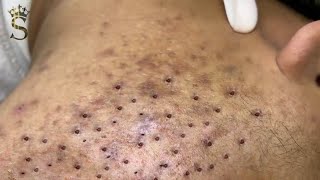 Big Cystic Acne Blackheads Extraction Blackheads amp Milia Whiteheads Removal Pimple Popping  3906 [upl. by Shuma]