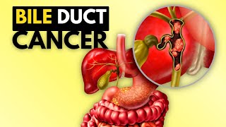 BIle Duct Cancer Cholangiocarcinoma Causes Signs and Symptoms Diagnosis and Treatment [upl. by Brick]