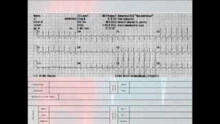 12 Lead Interpretation Part 62 EKG Changes and Lead Localization of Myocardial Infarctions [upl. by Granthem]