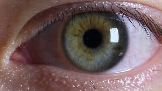 Central and Sectoral Heterochromia amp Limbal ring [upl. by Woodcock]