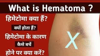 Hematoma क्या है Blood collection में हिमेटोमा होने के कारण बचाव के उपाय और होने पर क्या करें [upl. by Lissy]