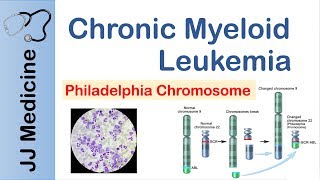 Chronic Myeloid Leukemia CML  Pathogenesis Symptoms and Treatment [upl. by Merrill]