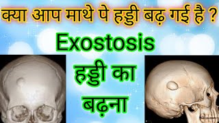 Exostosis bone growth on scalp bone growth on skull homeopathy for cure [upl. by Aisha165]